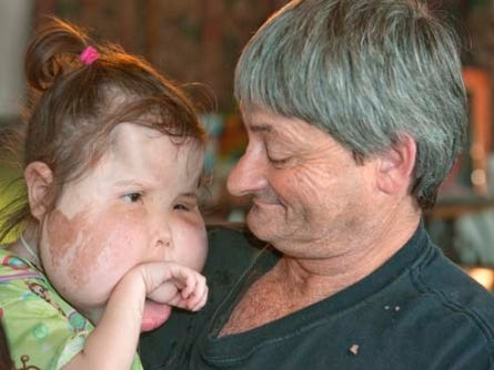 Dan Renfroe holds his daughter Katie Wednesday at their home in Paxton. The Renfroe family returned Tuesday from Hollywood, Fla., where doctors removed a 1-pound mass from her left cheek.