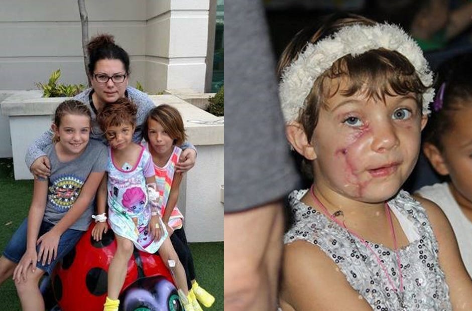 LEFT: Paige Woody is pictured with her three daughters, Gabby, Zoey and Olivia (from left) recently in Crestview. RIGHT: A skin graft and eye lift are among the procedures scheduled for Zoey Green this summer. Surgeons will repair the long facial scar in March, and reassess further needs at that point. [Special to the News Bulletin]
